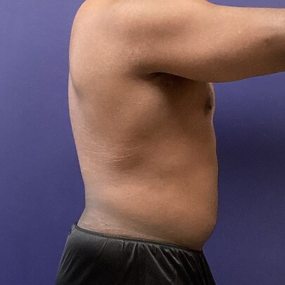 Side angle of male after stomach and waist procedure