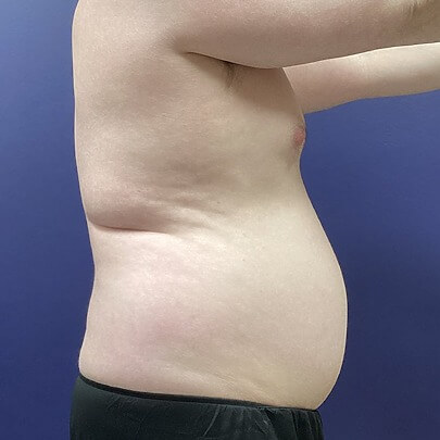 Side angle of male before stomach, back and waist procedure