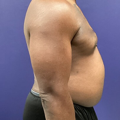 Side angle of male before stomach and waist procedure