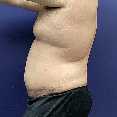 Side Angle of Male Stomach After AbEX Procedure