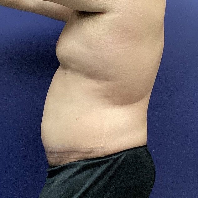 Loose Skin Removal for Men | Sono Bello Excess Skin Solutions