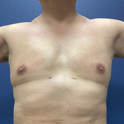 Front Angle Male Stomach After ChestEX