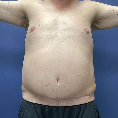 Front Angle of Male Stomach After Liposuction