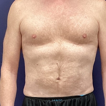 Front angle of male stomach after liposuction procedure