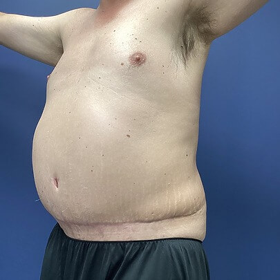 Side Angle of Male Stomach After Liposuction