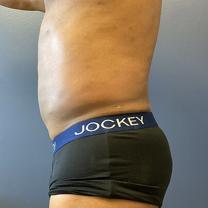 Side angle of male after Lipo stomach, waist and lower back procedure