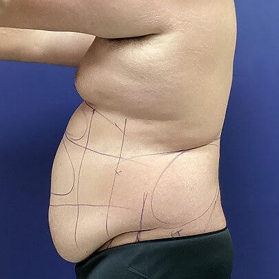 Side Angle of Male Stomach Before AbEX Procedure