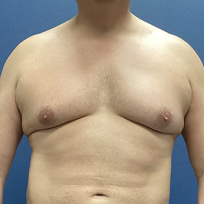 Front Angle Male Stomach Before ChestEX