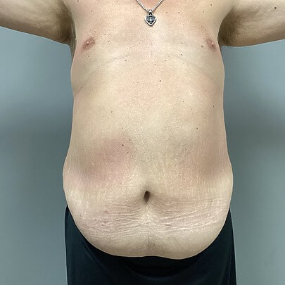 Front Angle of Male Stomach Before Liposuction