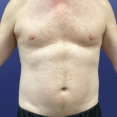 Front angle of male stomach before liposuction procedure