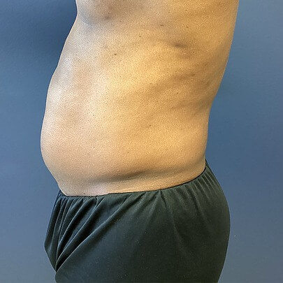 Side angle of male before Lipo stomach, waist and lower back procedure