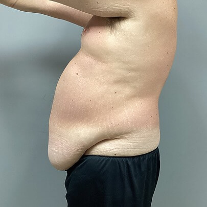 Side Angle of Male Stomach Before Liposuction