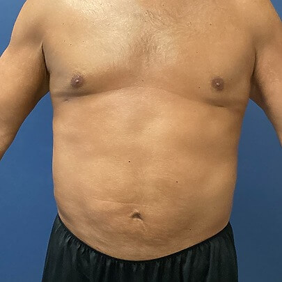 View of Male Chest Waist Stomach After Liposuction Front