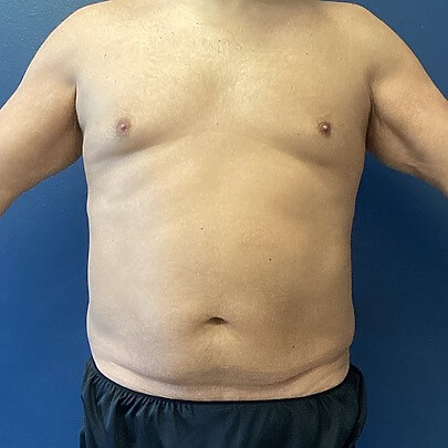 View of Male Chest Waist Stomach Before Liposuction Front