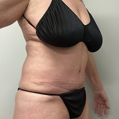 Side angle of female after AbEX stomach and waist procedure