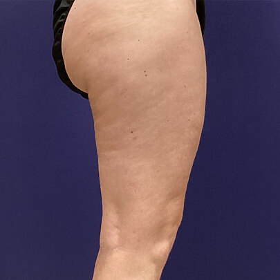 Side angle of female after Lipo thigh procedure-2
