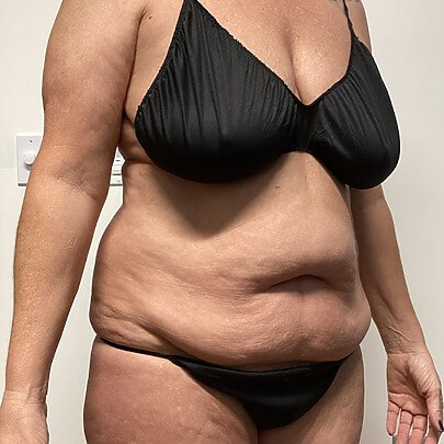 Side angle of female before AbEX stomach and waist procedure