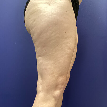 Side angle of female before Lipo thigh procedure-2