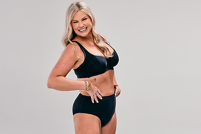 Sono Bello patient results after awake liposuction procedure