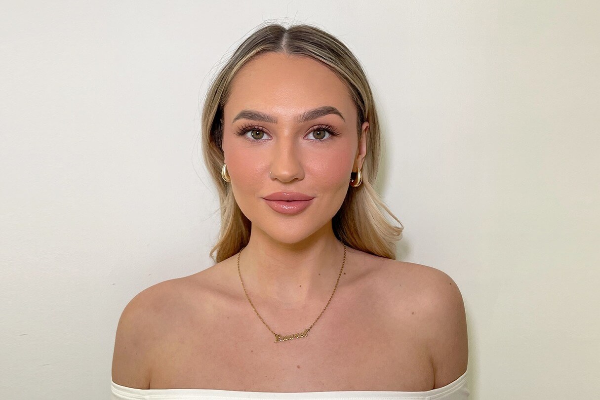 Sono Bello patient with defined jawline after chin liposuction