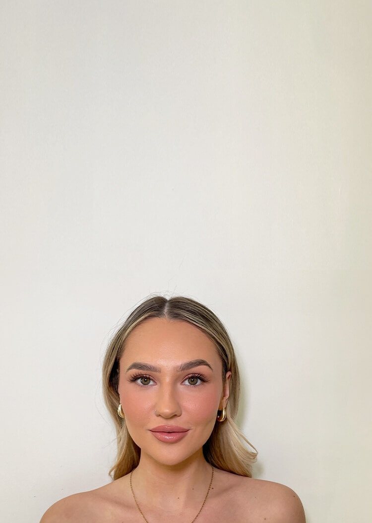 Sono Bello patient with defined jawline after chin fat removal