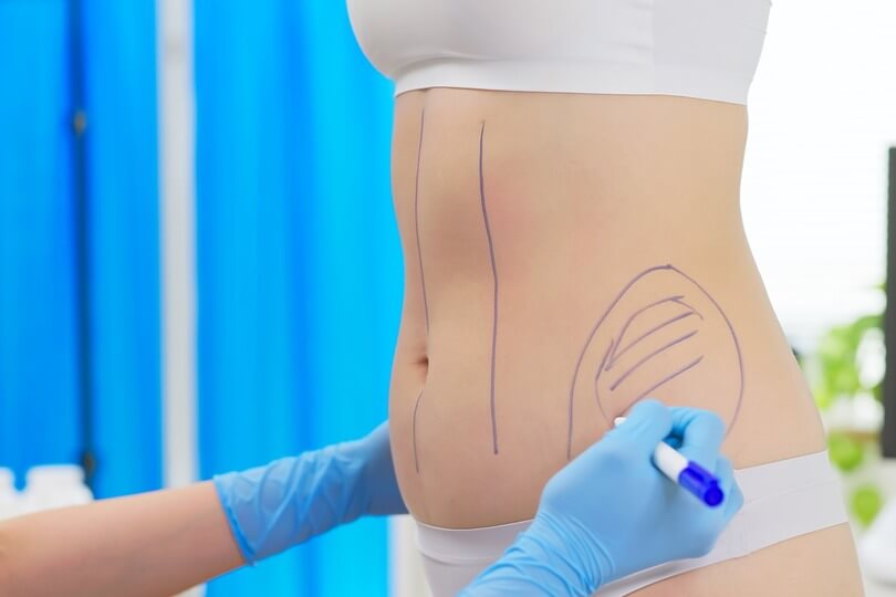 Preparing patient for stomach fat removal procedure