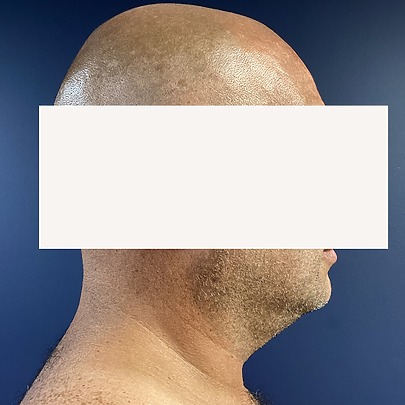 Sono Bello patient before chin liposuction for men