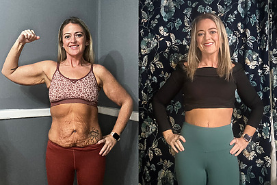 Addy before and after AbEX skin tightening in Charleston