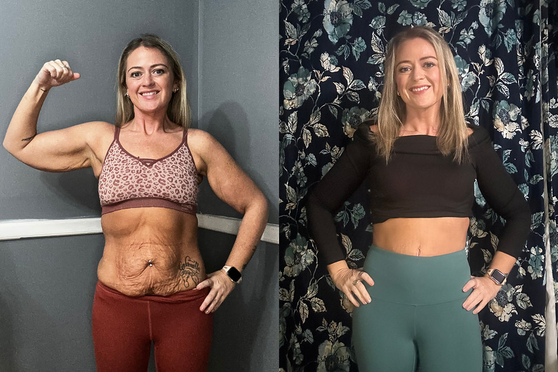 Addy before and after AbEX skin tightening in Charleston