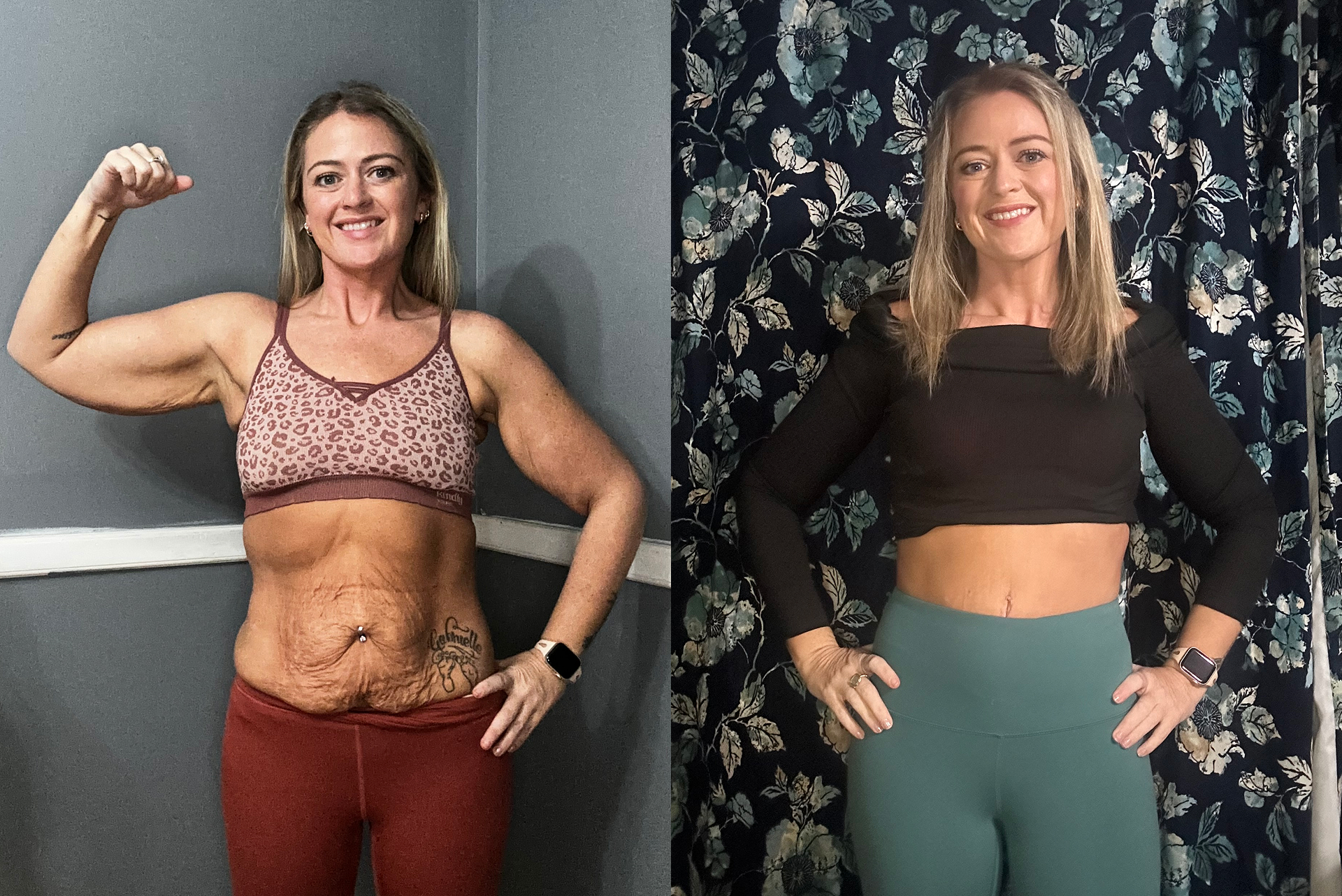 skin removal after glp-1 in jacksonville Addy's Sono Bello Transformation