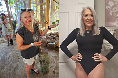 Angela before and after Sono Bello excess skin removal procedure