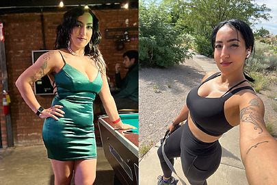 Sono Bello patient before and after AbEX™ and TriSculpt® liposuction in Albuquerque