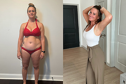 Sono Bello Patient Before and After AbEX in Charlotte, NC