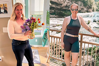 Jamie before and after AbEX™ and TriSculpt® micro-laser liposuction