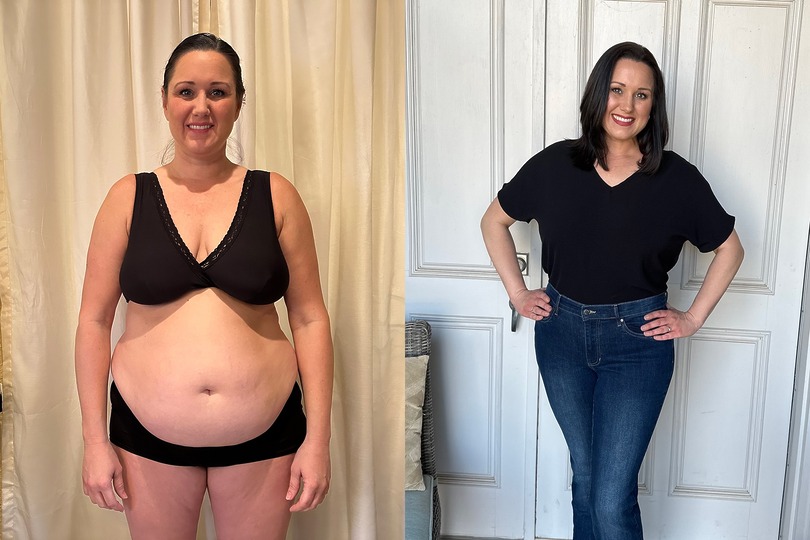 Sono Bello patient before and after TriSculpt and AbEX