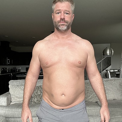 Male Sono Bello patient before liposuction procedure