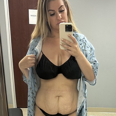 Sarah B before Sono Bello lipo & excess skin removal procedure