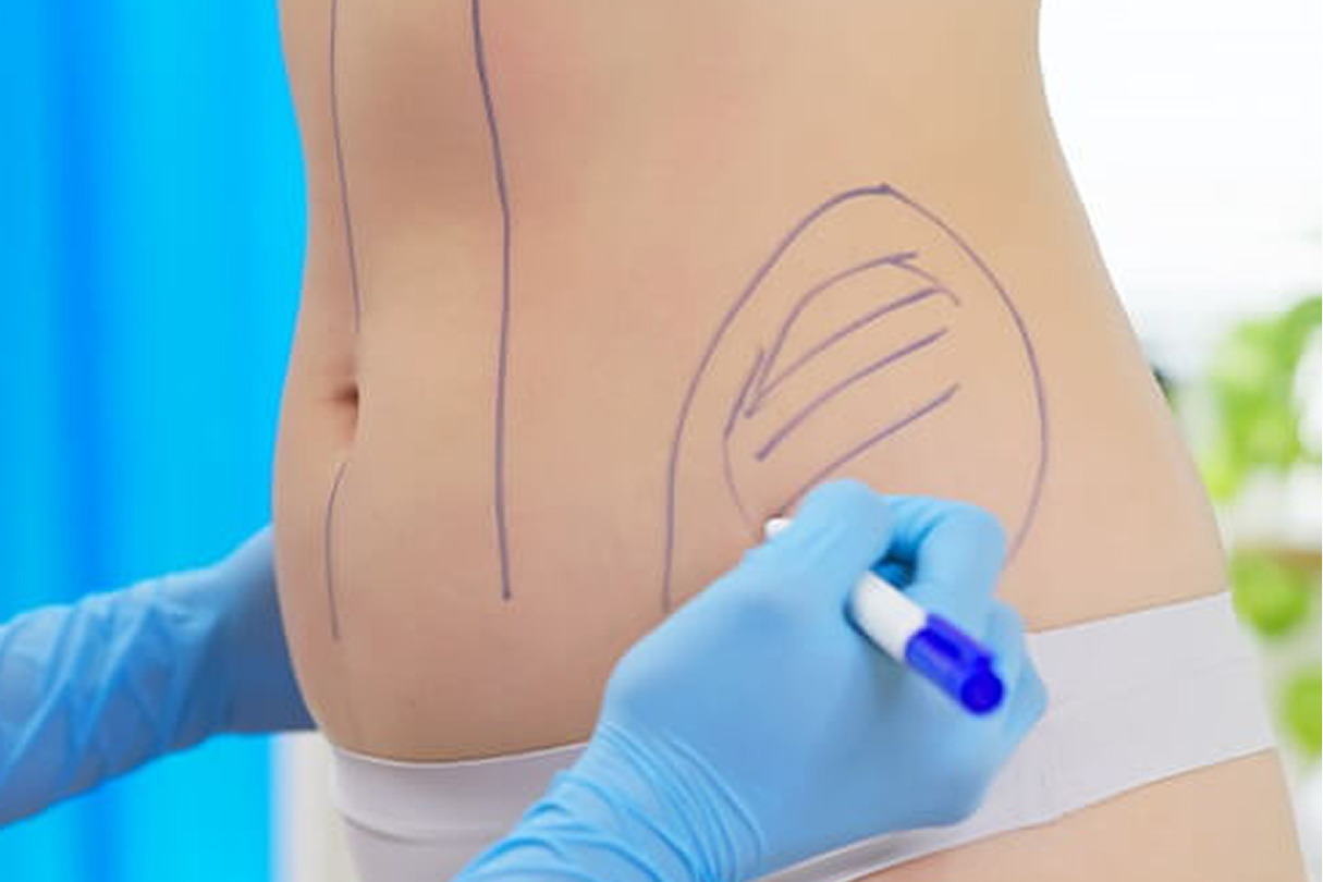 Person with surgical marks on abdomen, blue glove holding pen, preparing for cosmetic surgery in a medical setting.