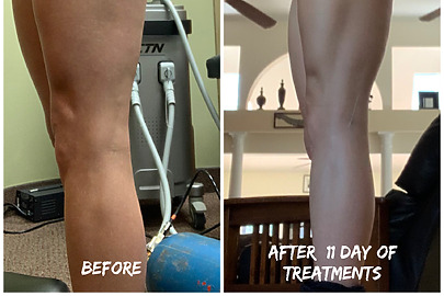 Legs before and after lymphatic drainage massage session using BallancerPro