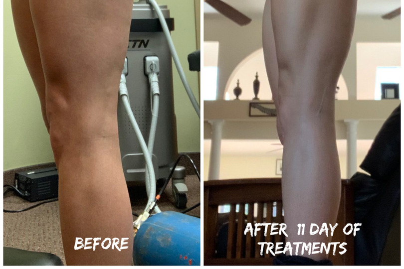 Legs before and after lymphatic drainage massage session using BallancerPro