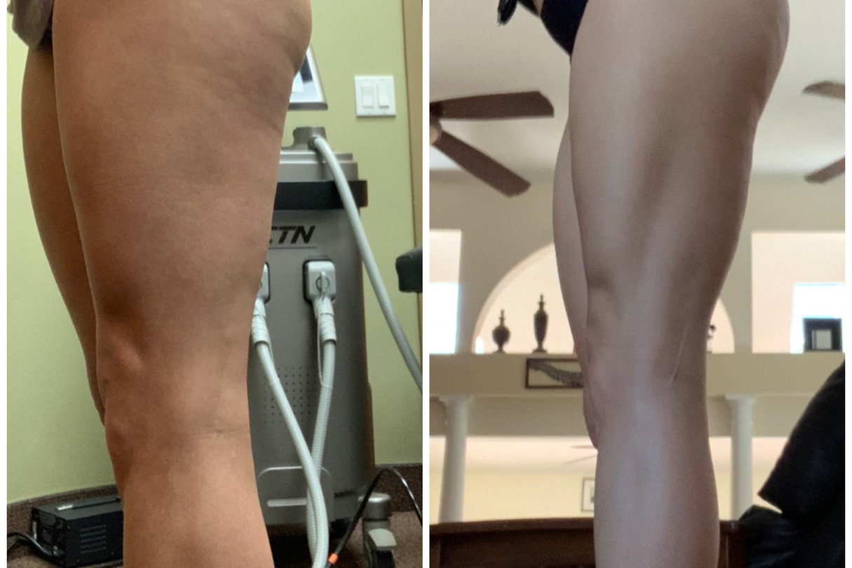 Lymphatic drainage massage before and after