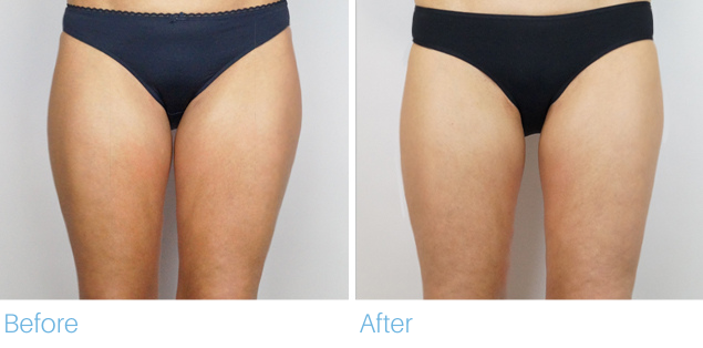 Before and after photo showing results of a cosmetic procedure on a woman's thighs wearing black underwear.