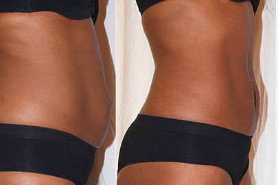 Before and after side-by-side comparison of a woman's midsection transformation showing noticeable changes in contour.