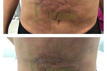 Close-up of a person's abdomen showing scars and bandages before and after a medical procedure.