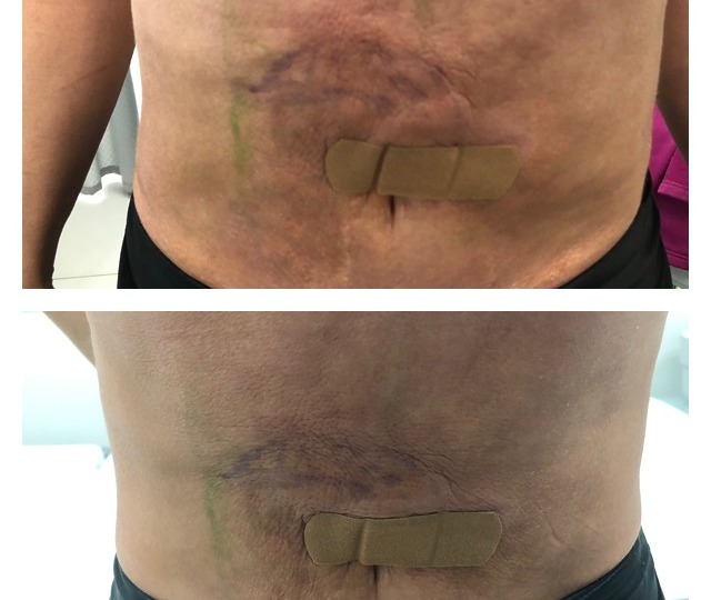 Close-up of a person's abdomen showing scars and bandages before and after a medical procedure.