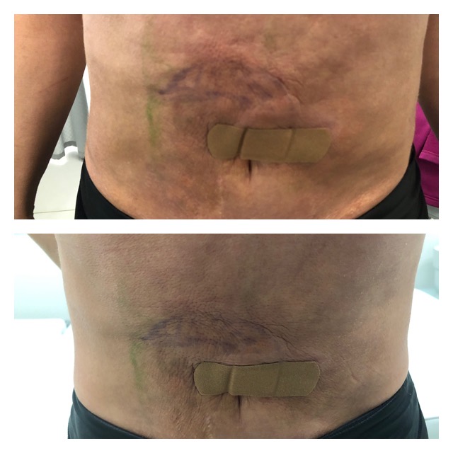 Close-up of a person's abdomen with a small adhesive bandage, showing different stages of healing in two separate images.