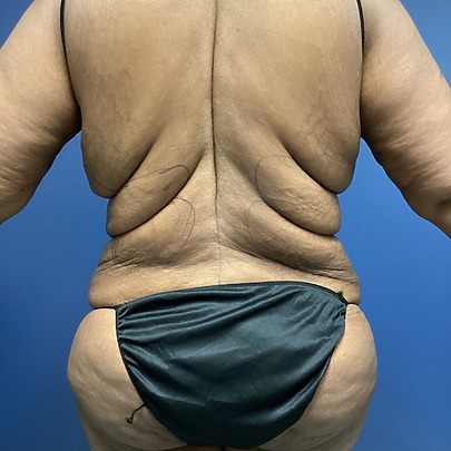 Person's back view with skin folds and black undergarment against a blue background.