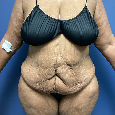 Person in dark swimwear, front view, with medical bandage on arm against a blue background.