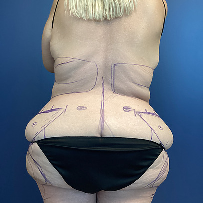 Person with markings on back and midsection, standing against a blue background, wearing a black swimsuit bottom.