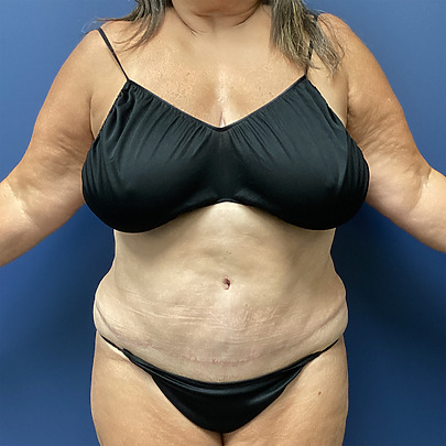 Woman in black swimwear standing against a blue background, showing her front and midsection with arms slightly extended.